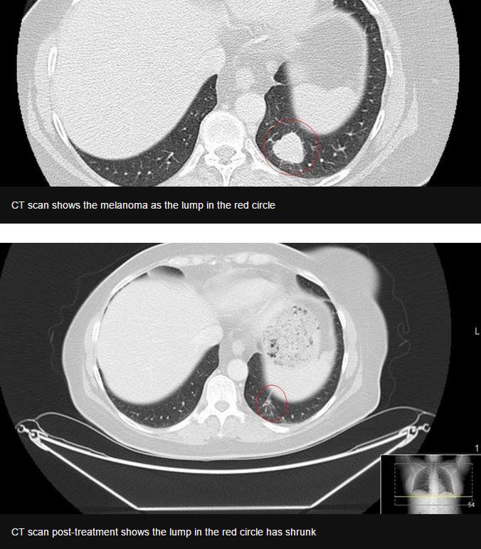 Cancer Treatment Shows 58% Success Rate